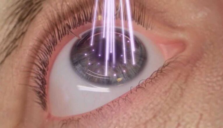 chirurgie des yeux au laser