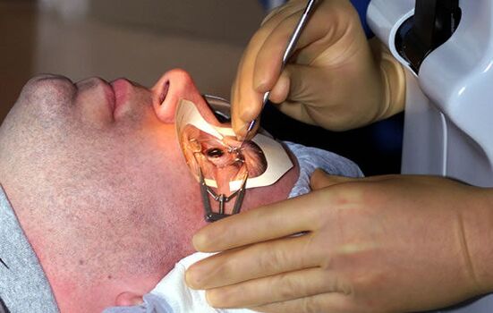 Scléroplastie pour myopie pour stabiliser la vision